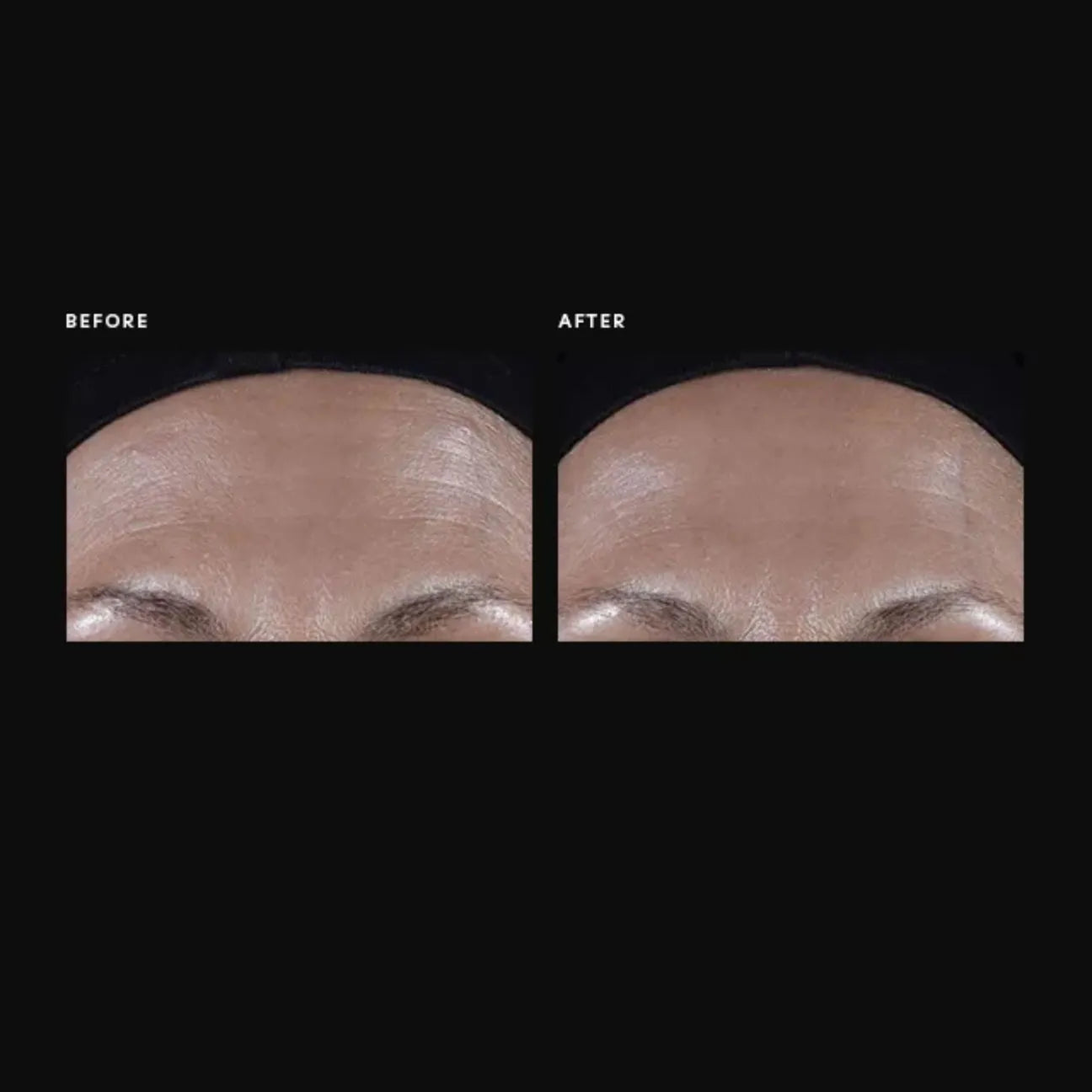 Before and after comparison of a person's forehead with visible wrinkles.