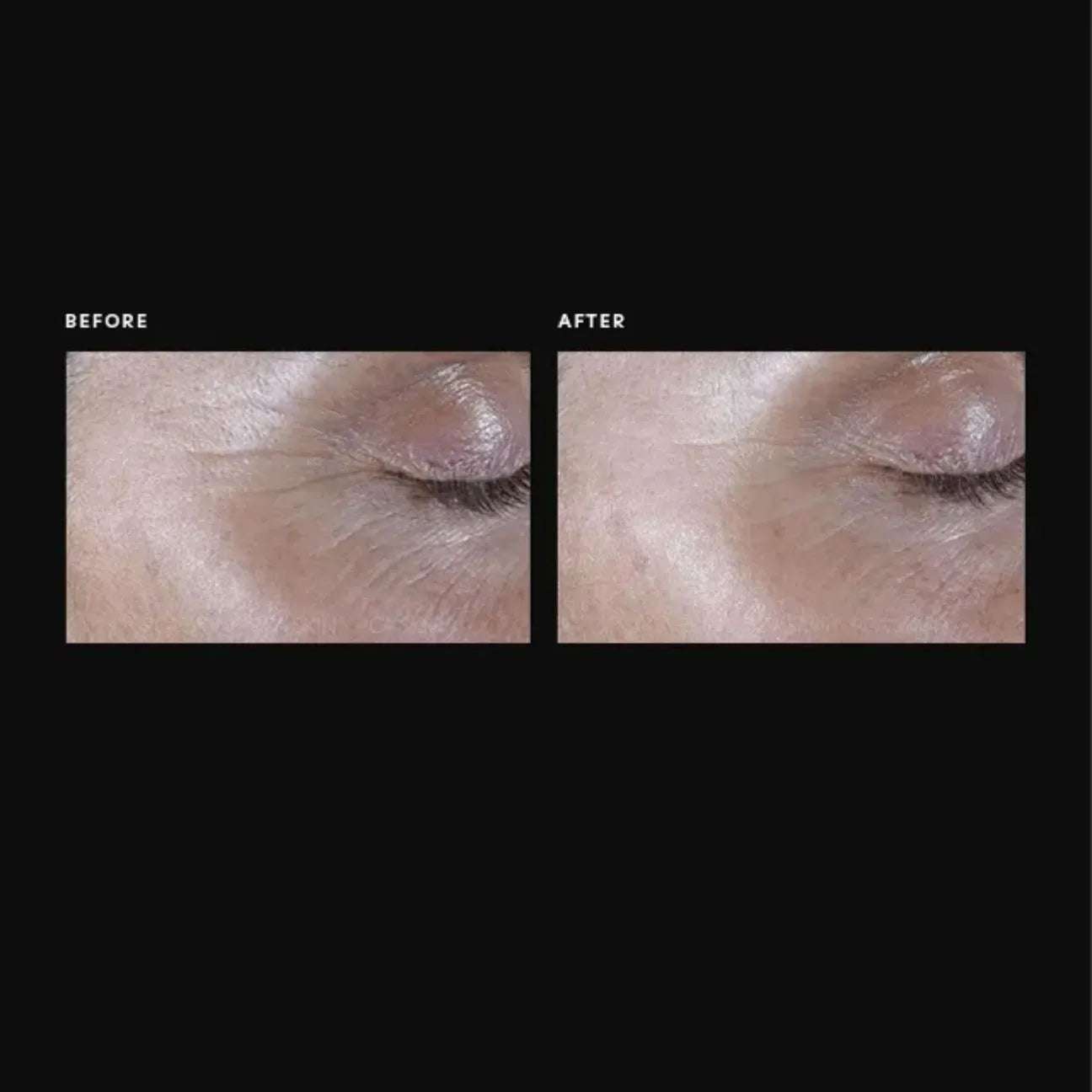 Before and after comparison of a eyelid with visible wrinkles.
